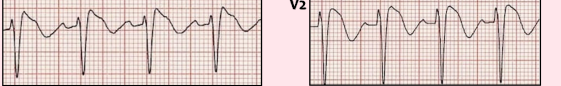 <p>Hereditary, characterized by structurally normal heart and associated with ventricular dysrhythmias</p><p>-Due to mutation in cardiac Na gene channel, predominantly in Asian men </p>