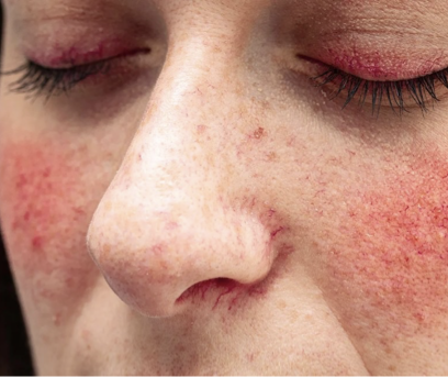 <p>chronic inflammatory disorder that primarily affects central face and is characterized by facial flushing, persistent erythema, visible small BVs, papules, and pustules; may also involve eyes and is triggered/worsens in the sun</p>
