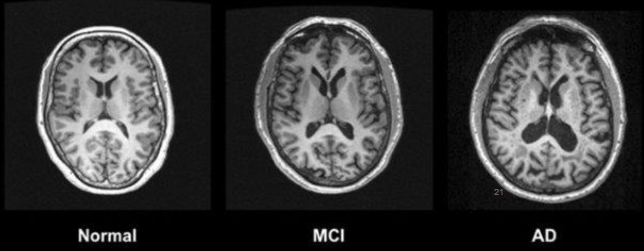 <p>• MCI may be associated with early stages of changes that are associated with dementia</p><p></p>