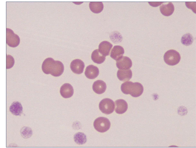 <ul><li><p>Microcytic, hypochromic non regenerative anaemia, hypoproteinemia (low PTP value) </p></li><li><p><span style="font-size: calc(var(--scale-factor)*17.52px);">Non inflammatory/infectious leucogram - <strong>right shift (likely,</strong></span><strong><br></strong><span style="font-size: calc(var(--scale-factor)*17.52px);"><strong>chronic disease)</strong></span></p></li><li><p><span style="font-size: calc(var(--scale-factor)*17.52px);">Image shows: microcytosis</span></p></li></ul><p><span>NON REGENERATIVE ANEMIA DUE TO MALABSORPTION SECONDARY TO EPI</span></p>