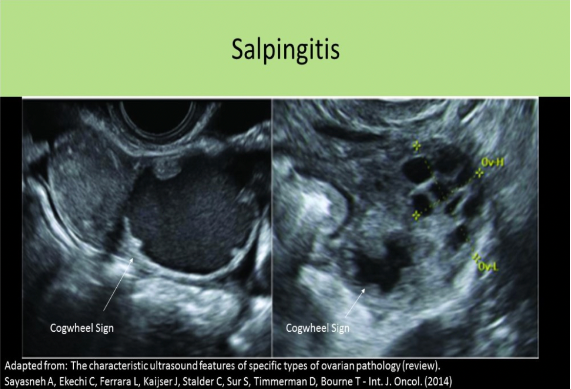 <p>B. cogwheel sign</p><p>4 Stages of PID:</p><p class="p1">Stage 1: Acute endometritis</p><p class="p1">Stage 2: Acute salpingitis - thick-walled with acute infection (>5mm); Cogwheel sign, free fluid in pelvis</p><p class="p1">Stage 3: Acute tubo-ovarian abscess</p><p class="p1">Stage 4: Chronic Infection: hydrosalpinx with thin-walled fallopian tube (<5mm); Beads-on-a-String sign</p>