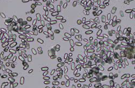 <p>Calcium Oxalate-Monohydrate Crystals</p>