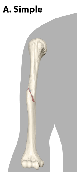 <p>break in which there is no open skin</p>