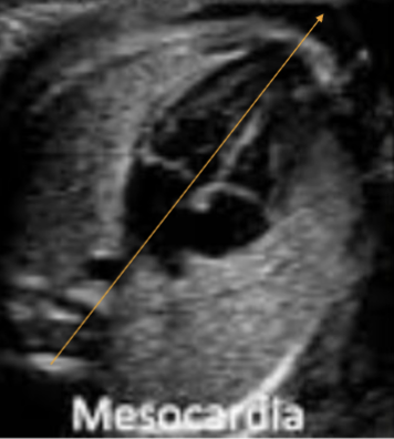 <ul><li><p>atypical location of heart, with cardiac apex <span style="color: red;">pointing toward midline</span> of the chest</p></li><li><p>heart is located more toward midline</p></li><li><p>this may be found with presence of an intracardiac mass or lung abnormality</p></li></ul><p></p>