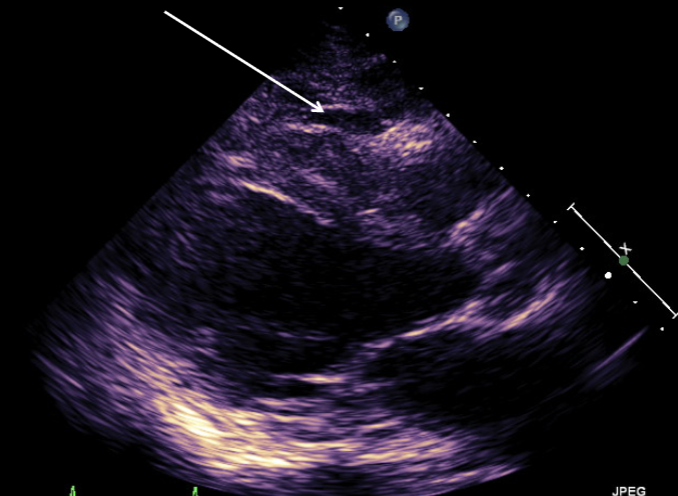 <ul><li><p>often located <u>anteriorly</u></p></li><li><p>sandwiched between <span style="color: rgb(0, 132, 255);">epicardium</span> and <span style="color: rgb(0, 139, 255);">myocardium</span></p><ul><li><p>seen <span style="color: rgb(255, 0, 246);">PLAX</span> if <strong>anterior</strong></p></li></ul></li><li><p>appears <u>anechoic</u> in this location</p><ul><li><p>can mimic loculated pericardial effusion</p></li></ul></li></ul><p></p>