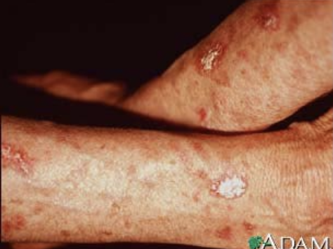 <p>Precancerous lesion caused by chronic sun damage; considered squamous cell carcinoma confined to the epidermis.</p>