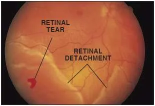<p>RF/E: high myopia (nearsightedness)<br>retinoschisis (split retina)<br>neoplasms<br>vascular dxs<br>trauma<br>etc.</p><p>CM: flashes<br>floaters<br>curtain/veil over vision<br>vision loss</p><p>TX: urgent retinal specialist referral→surgery</p><p>P: macula on→better vision prognosis→more of an emergency</p>