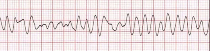 <p>the image shown depicts what cardiac arrhythmia?</p>