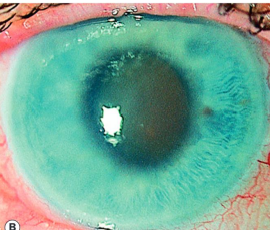 <ul><li><p>High IOP (50-100 mmHg)</p></li><li><p>Corneal edema</p></li><li><p>Mid-dilated pupil</p></li><li><p>Conjunctival injection</p></li></ul><p></p>