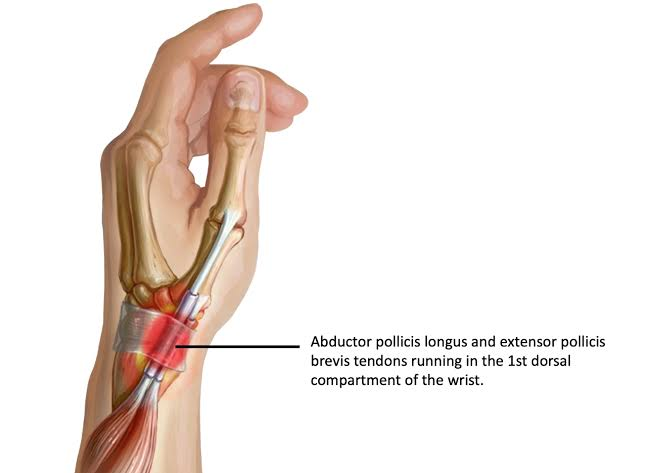 <p>1st dorsal compartment; surgical intervention is done to release the dorsal carpal ligament</p>