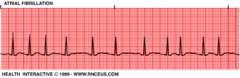 <p>-No P wave</p><p>-ALWAYS irregular</p>