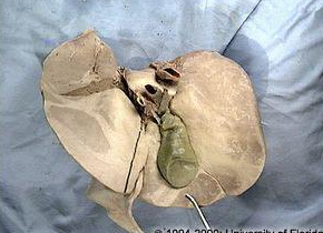 <p>what lobe of the liver is this?</p>