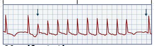 <p>Paroxysmal Supraventricular Tachycardia (PSVT)</p><ul><li><p>manifestations (7) what is the key? (1) (HR)</p></li><li><p>what to think about</p></li><li><p><strong>reentrant phenomenon</strong></p></li><li><p>paroxysmal refers to ____</p></li><li><p>associated with (6)</p></li></ul><p></p>