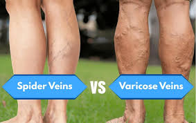 <p>Protruding, bulbous, distended superficial veins; light massage is indicated for severe cases.</p>