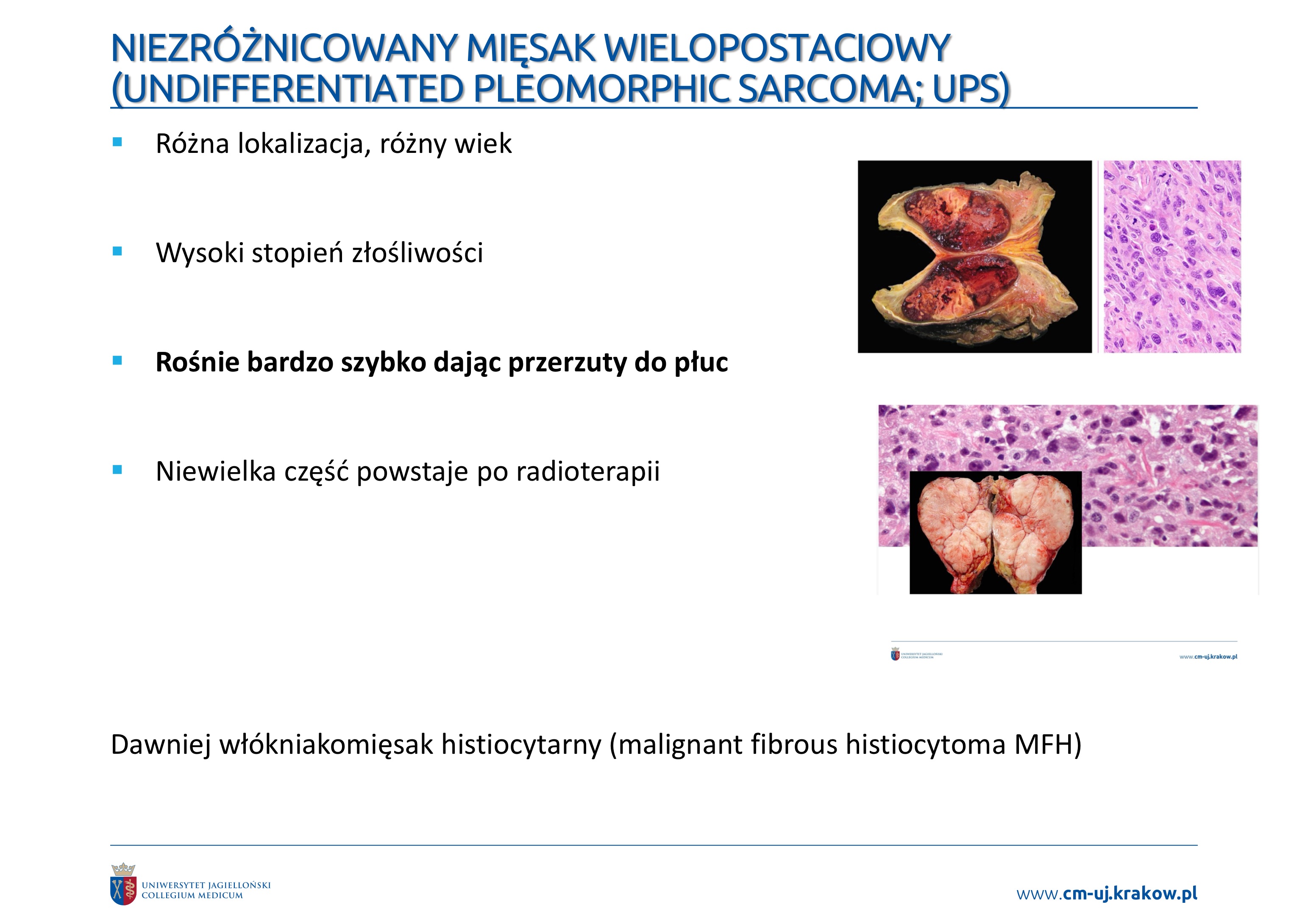 <p>: Mięsaki nie wykazujące kierunku różnicowania:</p><p>• Obraz mikroskopowy</p><p>• Immunohistochemia</p><p>• Biologia molekularna</p><p>Konieczne wykluczenie innych mięsaków a także sarkomatoidnych raków i</p><p>czerniaków.</p><p></p><p><span data-name="black_small_square" data-type="emoji">▪</span> Różna lokalizacja, różny wiek</p><p><span data-name="black_small_square" data-type="emoji">▪</span> Wysoki stopień złośliwości</p><p><span data-name="black_small_square" data-type="emoji">▪</span> Rośnie bardzo szybko dając przerzuty do płuc</p><p><span data-name="black_small_square" data-type="emoji">▪</span> Niewielka część powstaje po radioterapii</p><p>Dawniej włókniakomięsak histiocytarny (malignant fibrous histiocytoma MFH)</p>