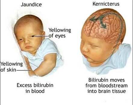 <p>Jaundice</p>
