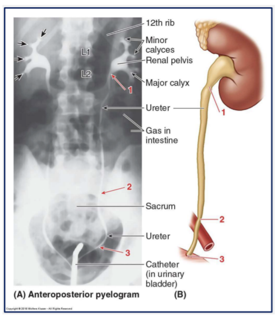 <ol><li><p><span>At the junction between the ureters and the renal pelvis</span></p></li><li><p><span>Where the ureters cross the brim of the pelvic bone</span></p></li><li><p><span>In the entrance of the ureters into the bladder</span></p></li></ol><p></p>