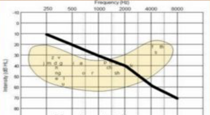 <p>what type of audiogram</p>