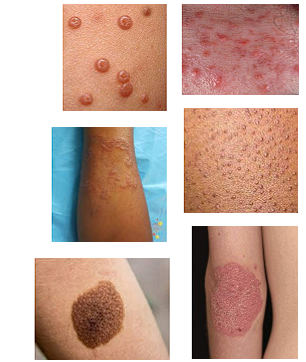 <p>Papules, plaques, and nodules</p>