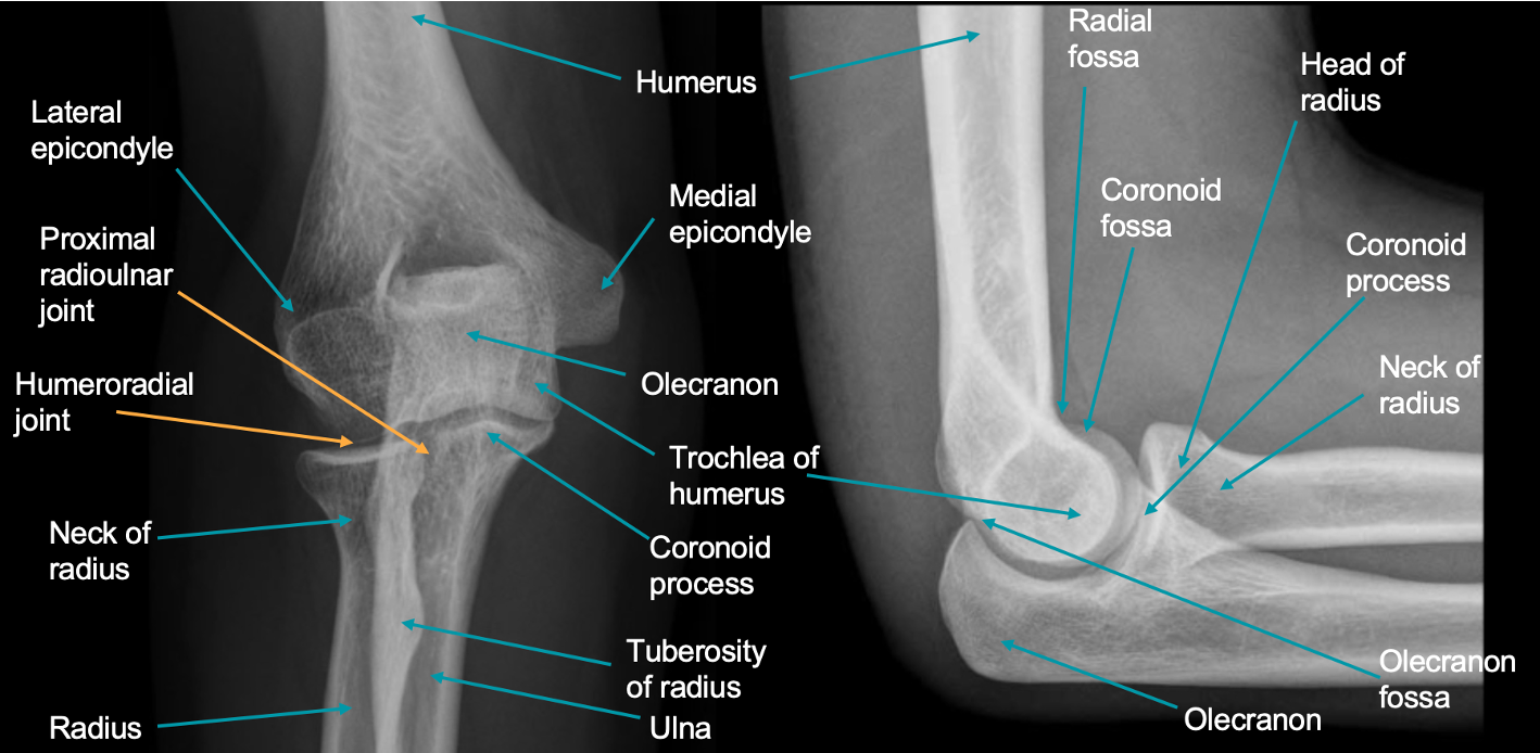<ul><li><p>Olecranon important </p></li><li><p>Medial and lateral epicondyle </p></li><li><p>Fractures </p><ul><li><p>Look for sail sign </p></li><li><p>Anterior and posterior </p></li><li><p>Anterior are typical and can be seen normally </p></li><li><p>Posterior almost always pathologic </p></li></ul></li></ul><p></p>