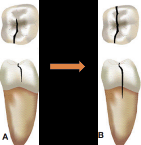 <p>What is a root fracture?</p>