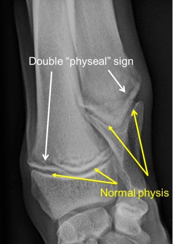 <p>Double physeal line</p>