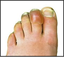 <p>edema, erythema, blister formation within 6-12 hours</p>