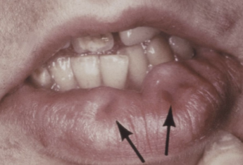 <p>congenital invagination of the lower lip, usually bilateral, no tx except to evaluate for van der woude syndrome </p>