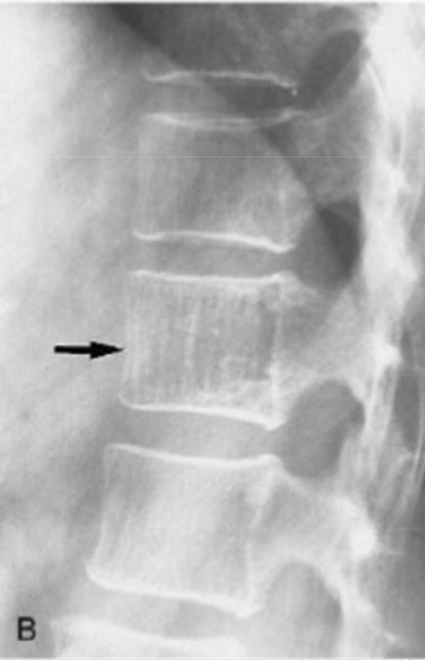 <p>A single vertebra with accentuated vertical trabeculae is a characteristic finding of a benign tumor-like condition of dilated capillaries</p>