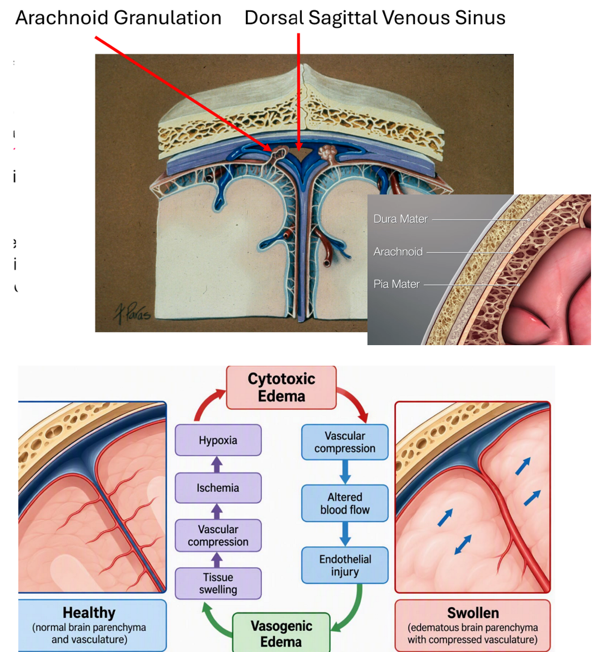 <p>1: fluid that leaks out combines w/ CSF &amp; gets reabsorbed via 2 ways…</p><ol><li><p>glymphatics system: glial cells (mainly astrocytes) push fluid thru lymphatics when you sleep</p></li><li><p>natural flow of CSF: fluid leaves ventricles &amp; drains into arachnoid granulations</p></li></ol><p>.</p><p>2: this system has a volume capacity (remember: CSF must be resorbed at constant rate bc its made at constant rate) so when capacity is exceeded → fluid stays in tissue → edema… + the CNS naturally has little extra space so BV’s are easily compressed → ischemia</p>