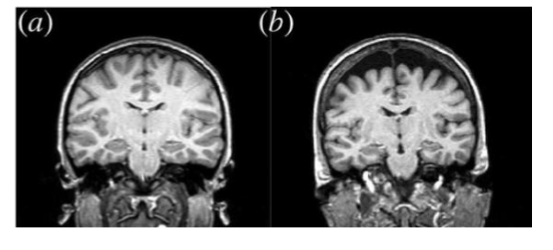 <p>Executive function declines with age </p><ul><li><p>Lesions in white matter </p></li><li><p>Loss of gray matter </p></li><li><p>Loss of dendritic branching</p></li></ul><p>Changes are highly variable </p><ul><li><p>Decline can be minimal in healthy aging </p></li><li><p>Influenced by things like lifestyle, education, genetics, etc. </p></li></ul><p></p>