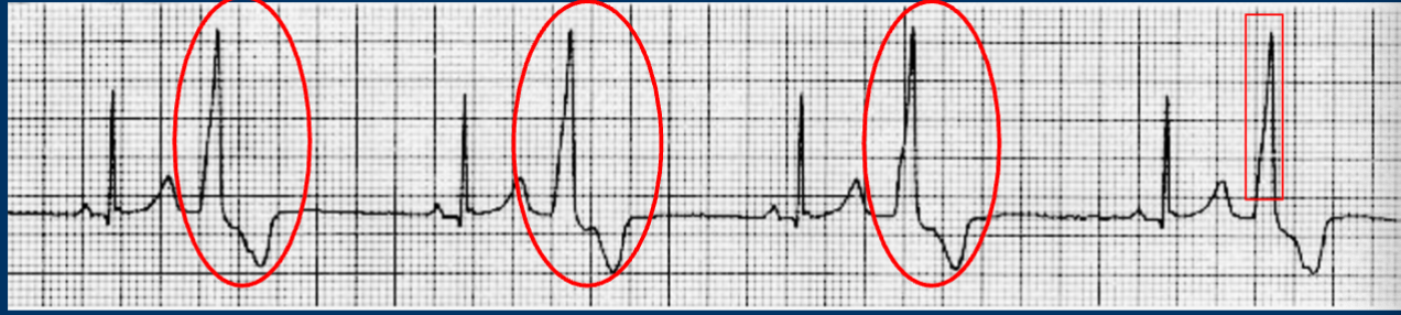 <p>Premature ventricular contractions if the pt is symptomatic what medication and nursing responsibilities must take place:</p>