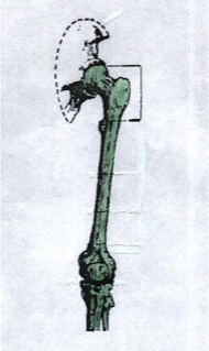 <p>hip disarticulation </p>