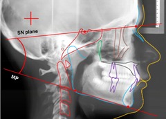 <p>What skeletal measurement:</p><p>- Sella-Nasion vs. Mandibular Plane</p><p>- Vertical relationship between the cranial base and the mandible</p><p>- Tells you about the vertical angulation of the mandible</p>