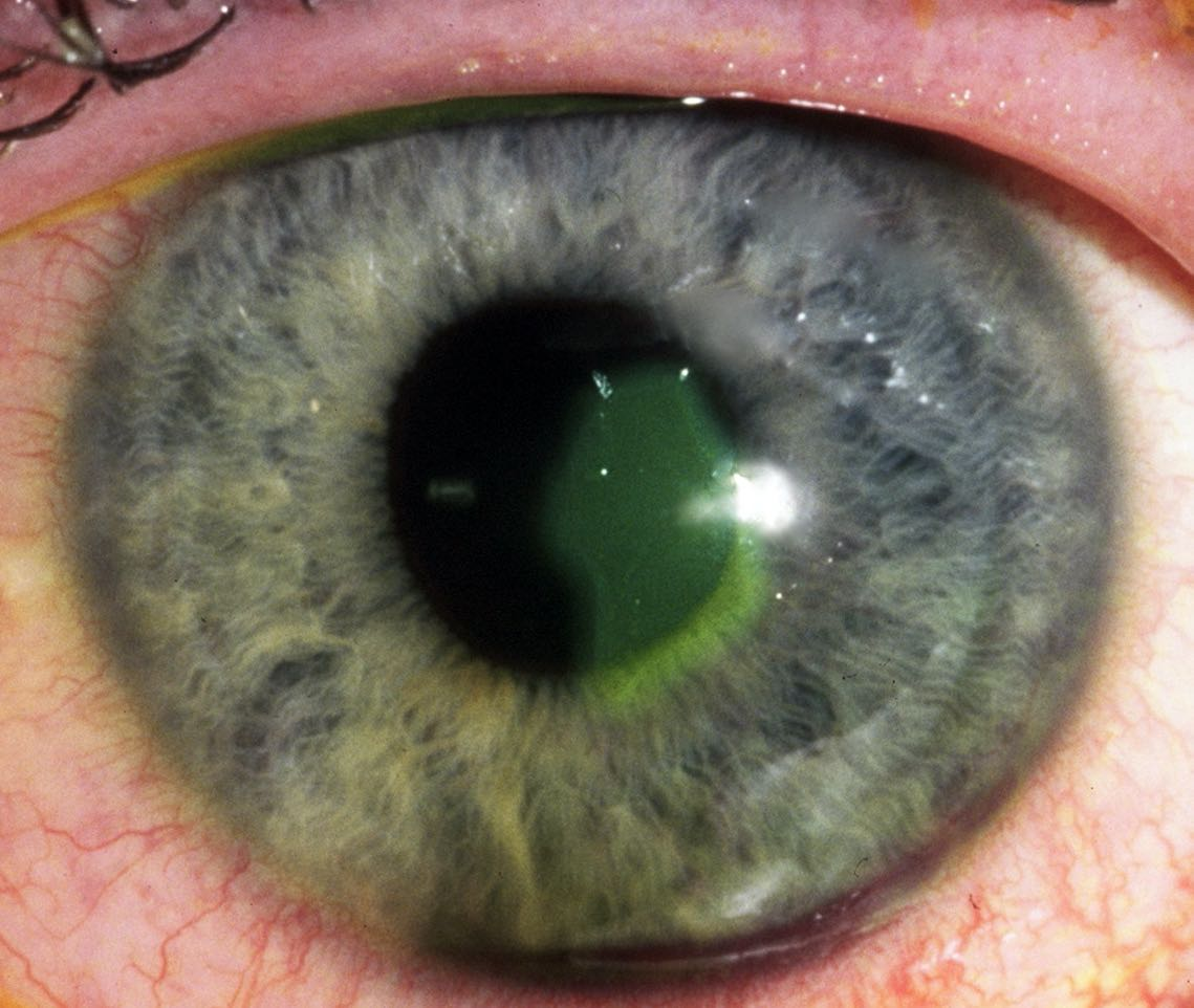 <p>Scratching the eye</p>