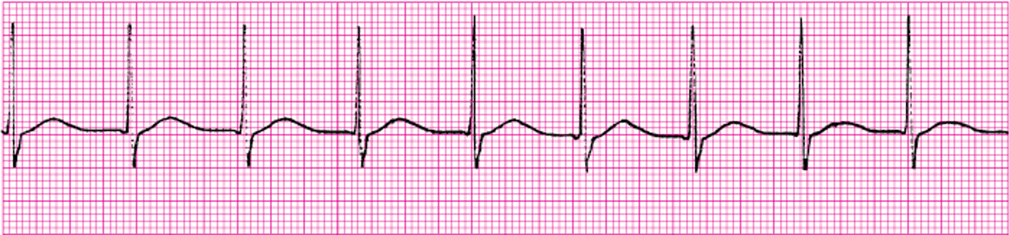 <p>What ECG is this? </p>