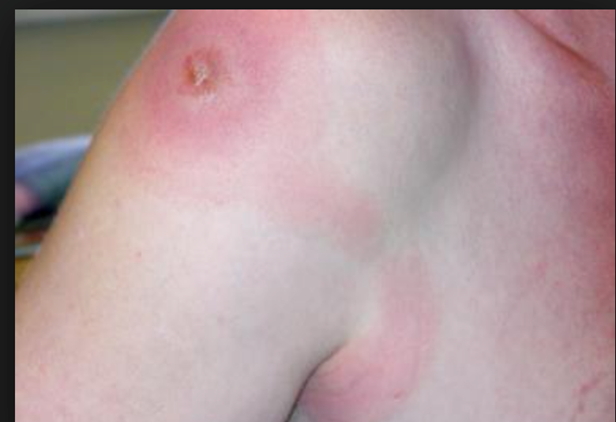 <p>Causative Agent: Staphylococcus aureus or Streptococcus pyogenes</p><p>Symptoms/Signs: Fever, lymph node swelling, red lines leading away from the site of infection</p>