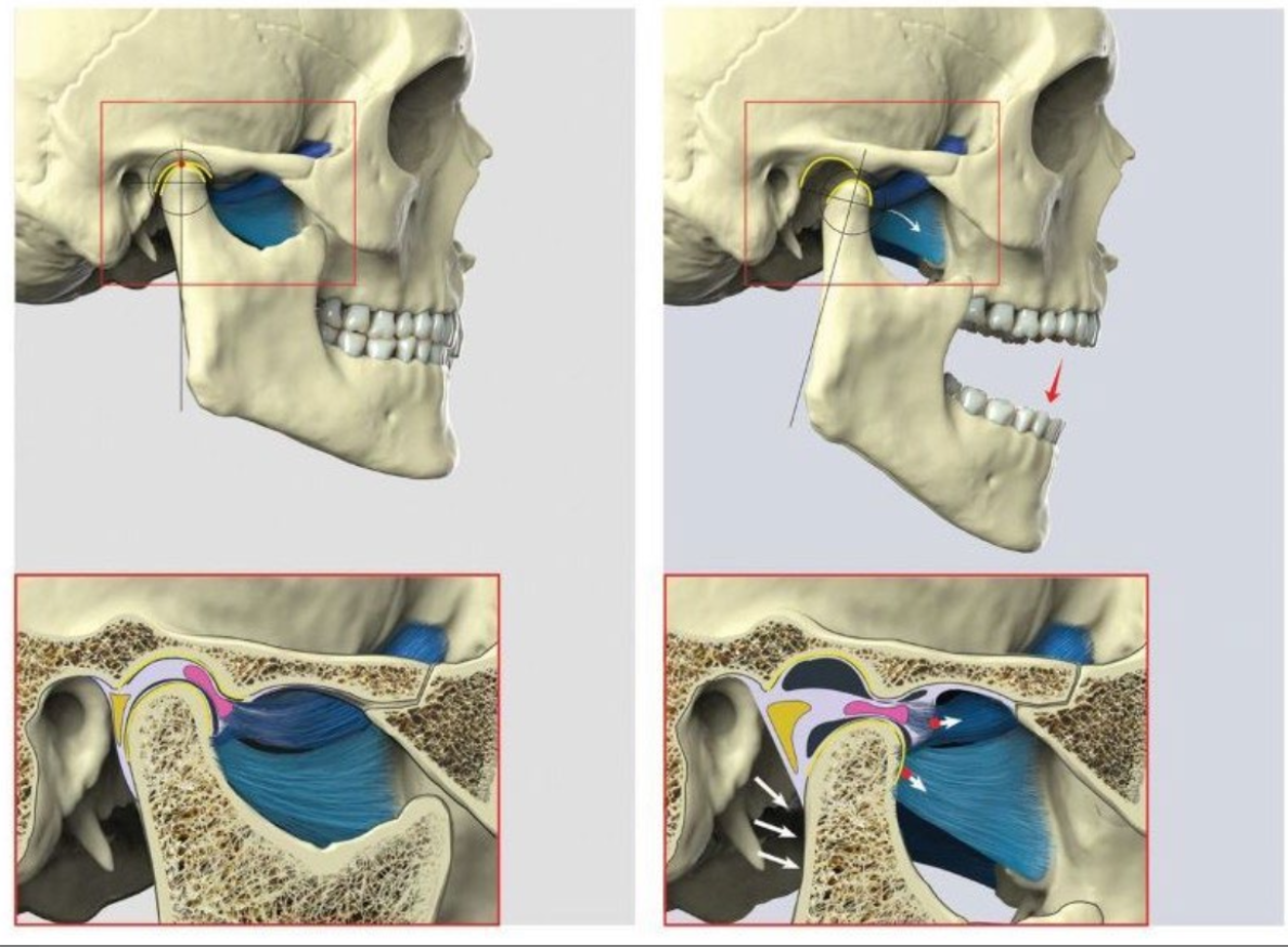 <ul><li><p>helps protrude mandible.</p></li><li><p>unilateral contraction pulls the mandible into a lateral excursive movement (contralateral side).</p></li><li><p>depresses the mandible and opens the mouth when assisted by the anterior belly of the digastric muscle and the mylohyoid muscle.</p></li></ul><p></p>