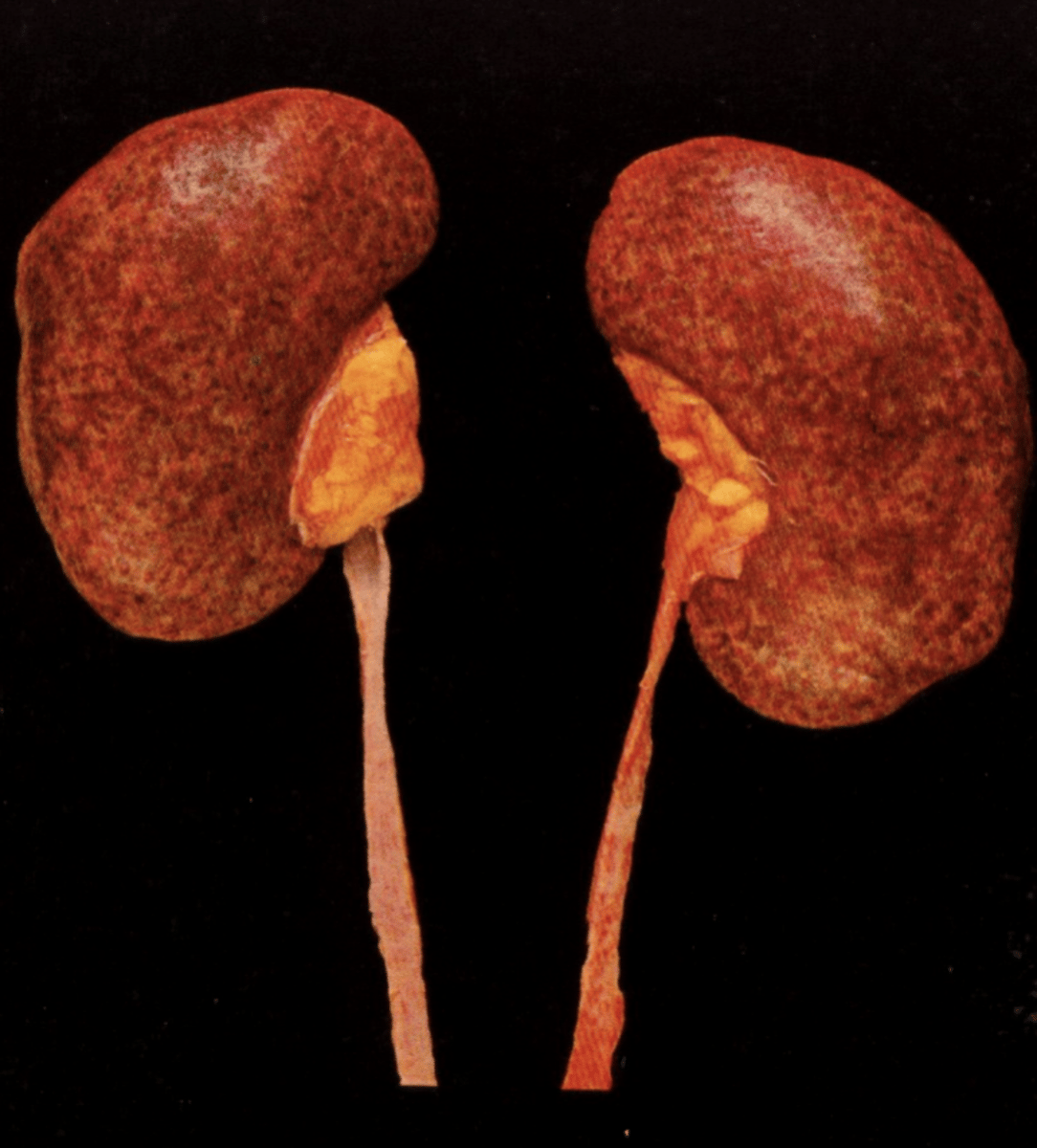 <p>Acute post-streptococcal glomerulonephritis</p>
