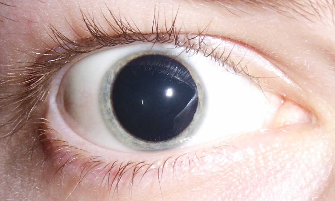 <p>dilated pupils </p>