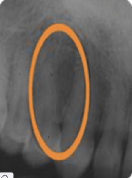 <p>lateral fossa/canine fossa</p>