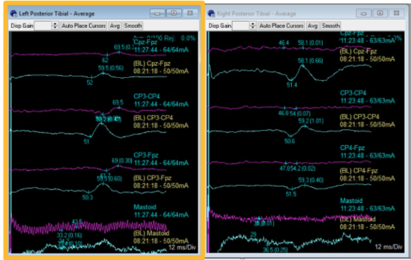 <p>This picture not only reflects a decrease in amplitude of the signals (purple is current trace, and blue is baseline), but also an increased ____. </p>