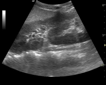 <ul><li><p>one kidney displaced across midline and the other fused to the other normally positioned kidney </p></li></ul><p></p>