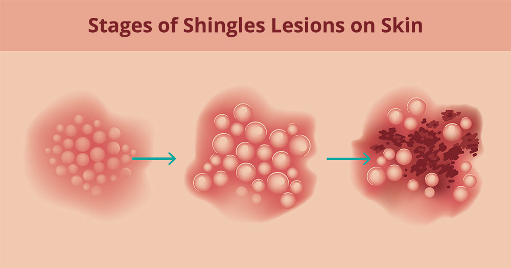 <p>Since Herpes simplex virus causes very painful, itchy lesions, what should patients NOT put on that infected area?</p>