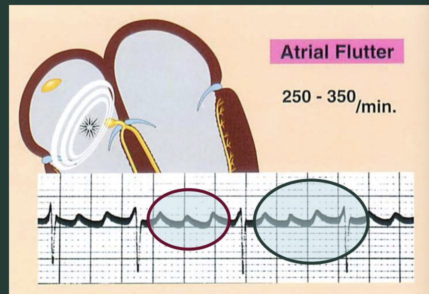 <p>What defines an atrial flutter?</p>