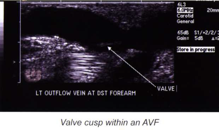 <ul><li><p>provides adequate blood flow</p></li><li><p>lasts longer than other types of access (can function up to 20 years) </p></li><li><p>lower complication rate</p></li><li><p>less likely to be infected/cause blood clots </p></li></ul><p></p>
