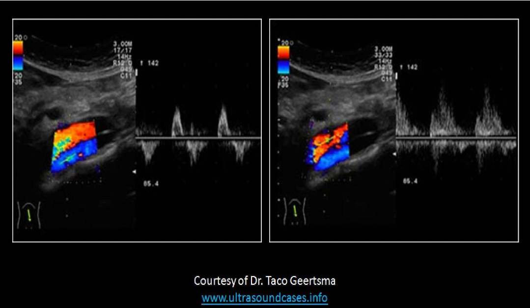 <p>The images displayed are from an aortic Doppler evaluation on an ER trauma patient. What should you do upon completion of the exam?</p><p>A. Leave a preliminary report with the nurse describing the dissection and send the exam to the PACS system for a stat interpretation by the radiologist.</p><p class="p1">B. Leave a preliminary report with the nurse describing the AV fistula and send the exam to the PACS system for a stat interpretation by the radiologist.</p><p class="p1">C. Leave a preliminary report with the nurse describing the mild atherosclerosis in the distal aorta but an otherwise normal exam.</p><p class="p1">D. Provide a preliminary report describing normal flow in the aorta and IVC.</p>