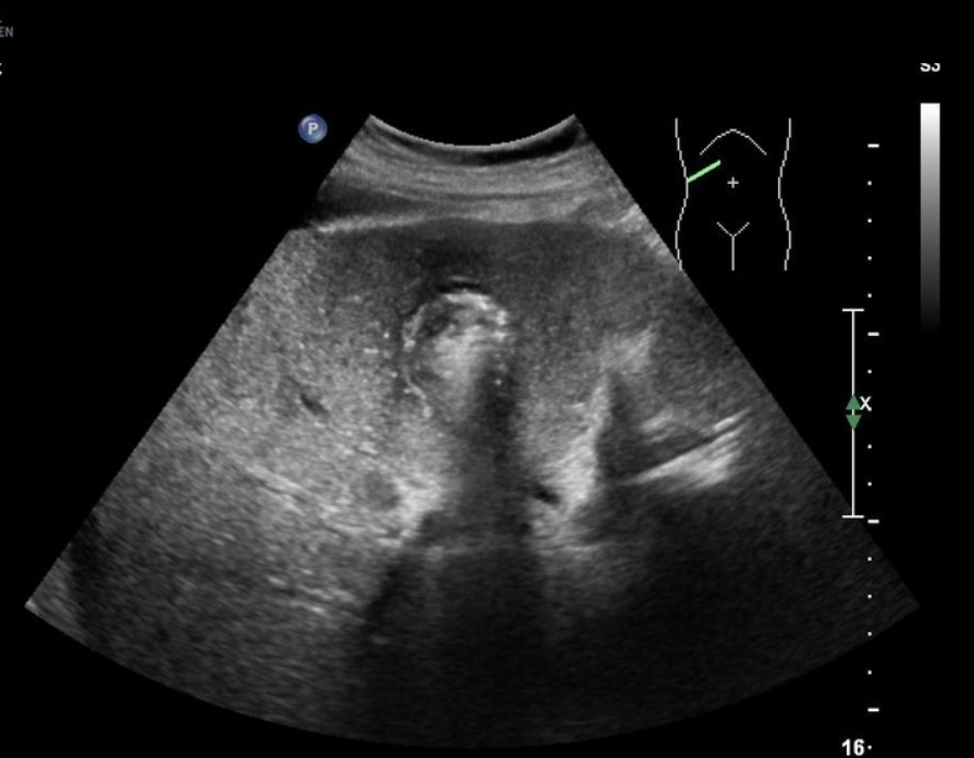 <p>A patient presents with RUQ pain and nausea 1 week post-cholecystectomy. These findings on the image are most suggestive of:</p><p>a. biliary stricture</p><p>b. abscess formation in GB fossa</p><p>c. biloma formation in GB fossa</p><p>d. porcelain GB</p>