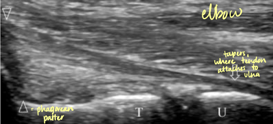 <ul><li><p>connective tissue that attach <span style="color: yellow;">bone to bone</span></p></li><li><p>types: collagenous, not flexible, or elastic</p></li><li><p>elastic ligaments can stretch and recoil as the bone moves</p></li><li><p>SONO: echogenic fibrillar appearance; not easily seen because they contain less cartilage</p></li></ul><p></p>