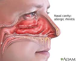 <p>Inflamación de la mucosa nasal</p>
